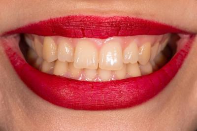 Tâches sur les dents : voici les...'s Image